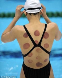 Sports Cupping - Swimmer
